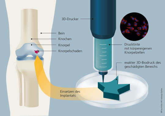 Reinforcement for the knee 3D bioprinting with the body’s own cartilage cells